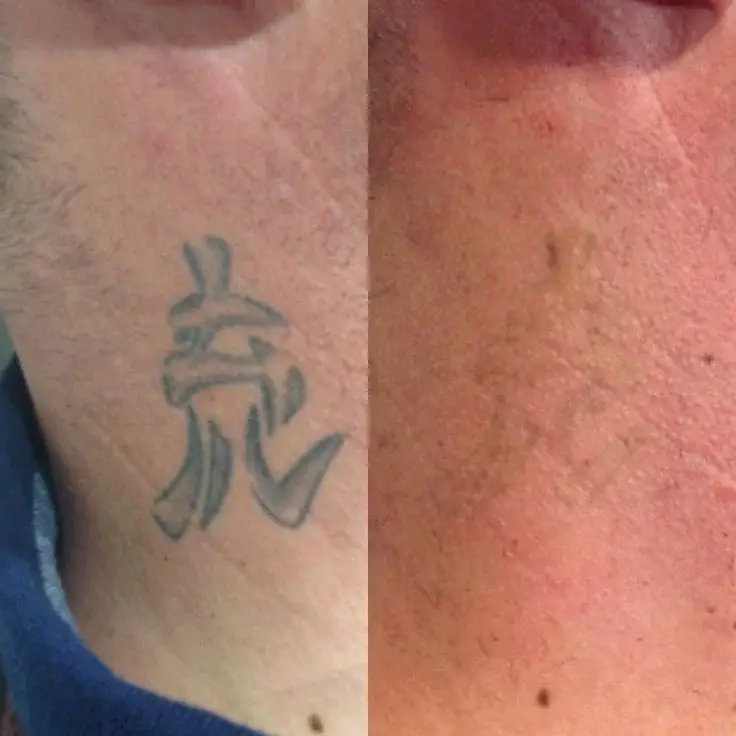 TATTOO REMOVAL — Rathnam Tattoos Studio