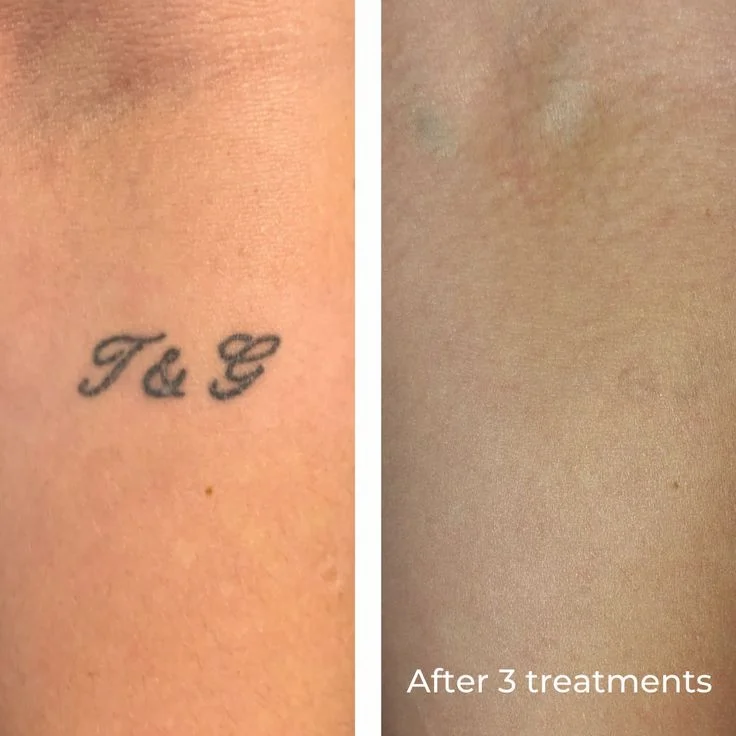 TATTOO REMOVAL example 3