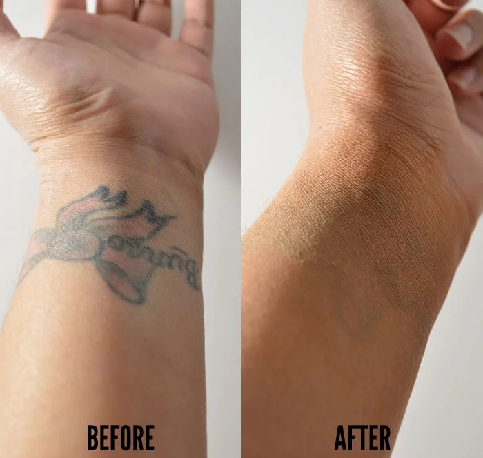 TATTOO REMOVAL example 4