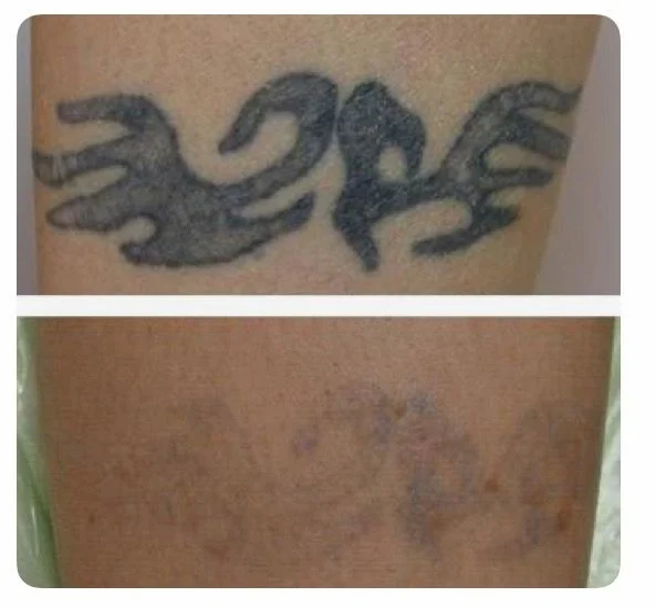 TATTOO REMOVAL example 6